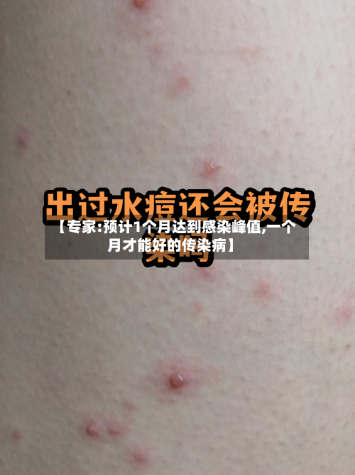 【专家:预计1个月达到感染峰值,一个月才能好的传染病】-第2张图片