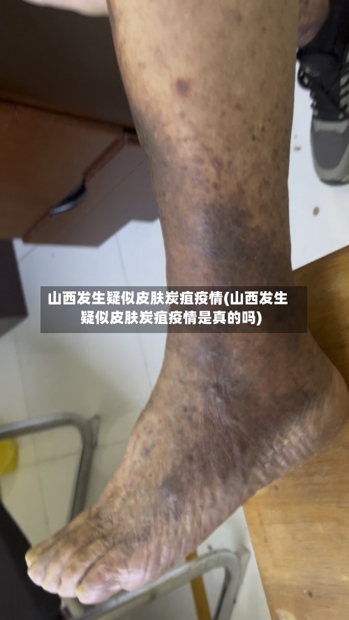 山西发生疑似皮肤炭疽疫情(山西发生疑似皮肤炭疽疫情是真的吗)-第2张图片