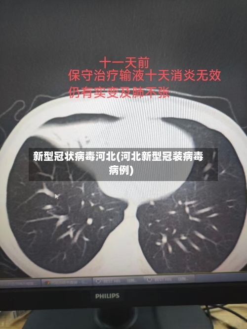 新型冠状病毒河北(河北新型冠装病毒病例)
