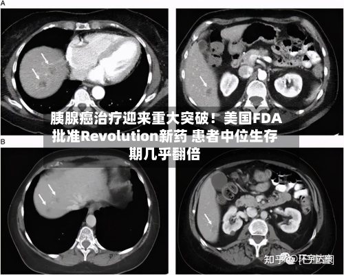 胰腺癌治疗迎来重大突破!美国FDA批准Revolution新药 患者中位生存期几乎翻倍-第2张图片